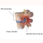 7 bài tập khi bị thoát vị đĩa đệm cột sống cổ